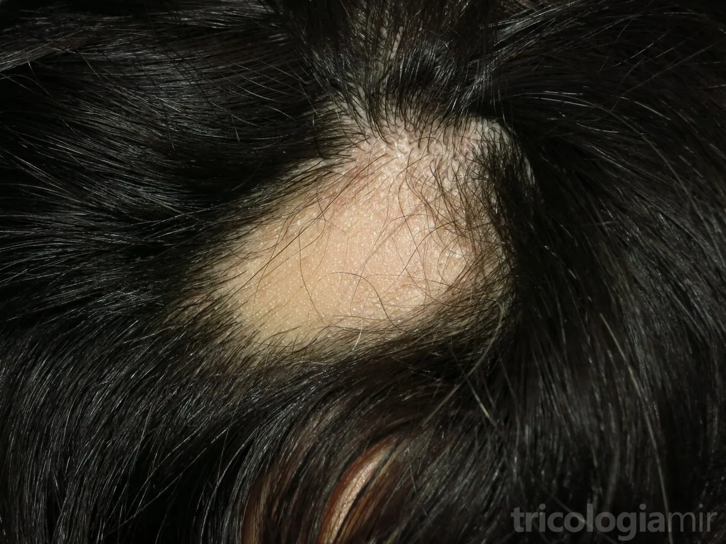 Placa única de alopecia areata