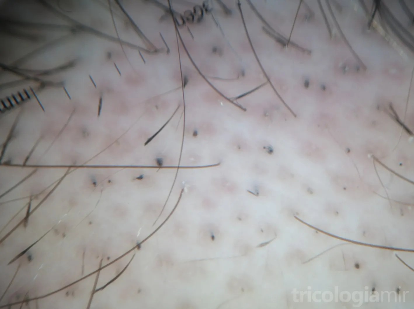 Tricoscopia de alopecia areata con pelos en signo de exclamación y puntos negros