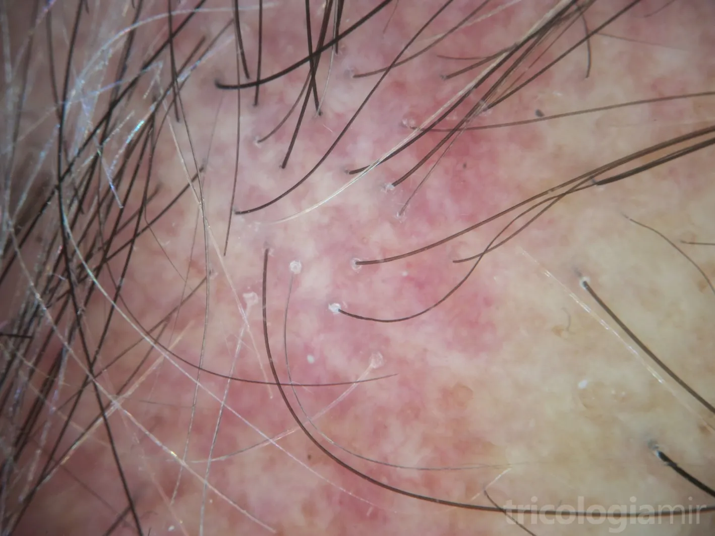 Tricoscopia de AFF con eritema difuso e hiperqueratosis folicular