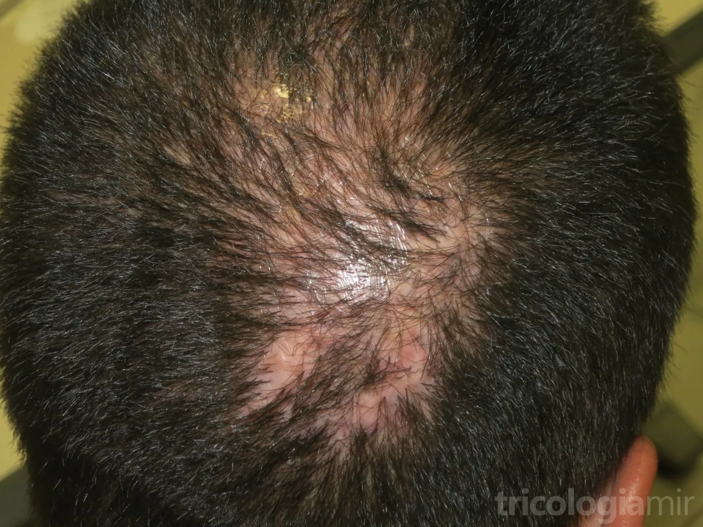 Foliculitis decalvans en fase estable con placas alopécicas cicatriciales parcheadas en vértex sin signos de inflamación activa