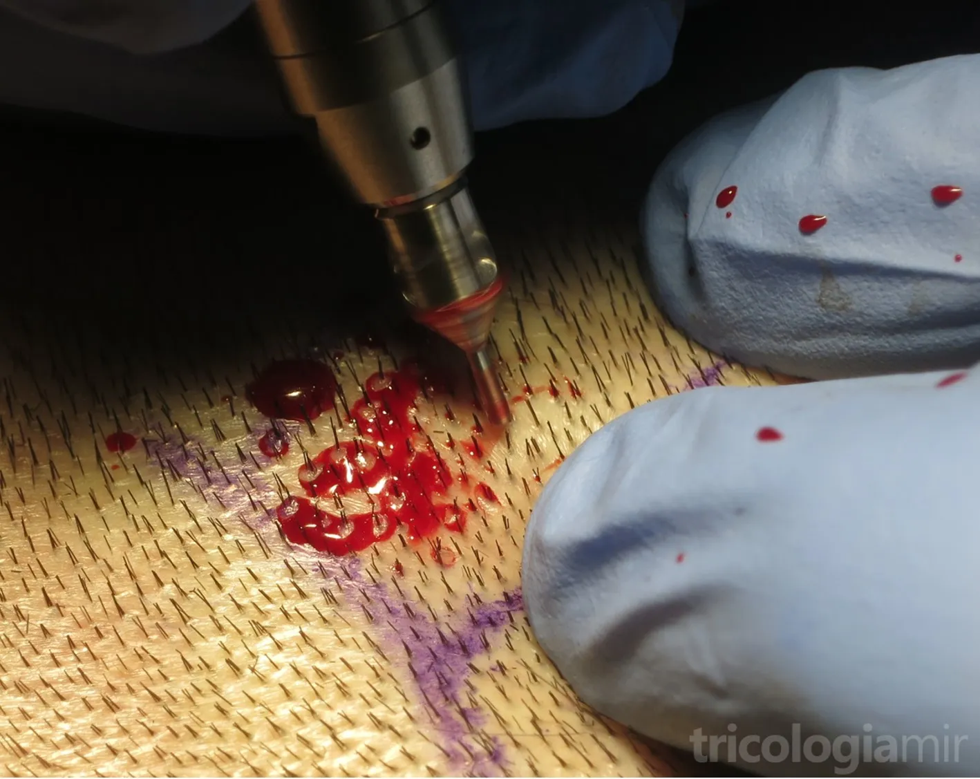 Extracción de las unidades foliculares mediante micropunch de 0,8 mm