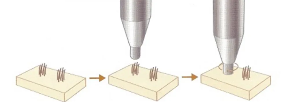 Técnica FUE de extracción por unidad folicular individual