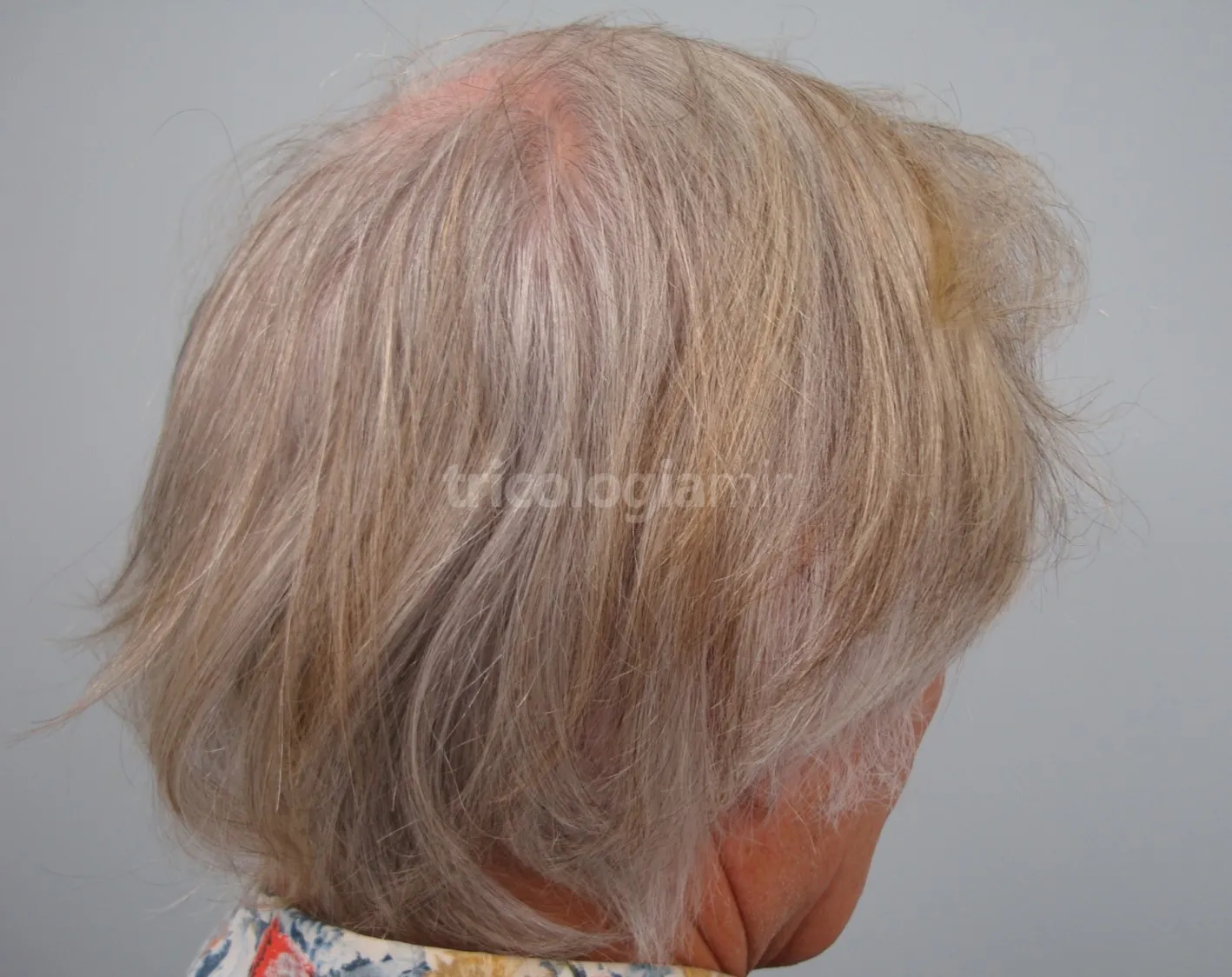 El pelo cubre totalmente la cicatriz, quedando totalmente invisible