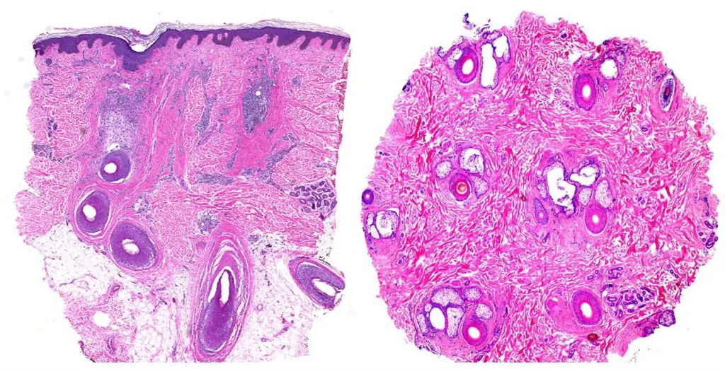 Comparación de imágenes histológicas de alopecia en cortes longitudinales (izquierda) y transversales (derecha).