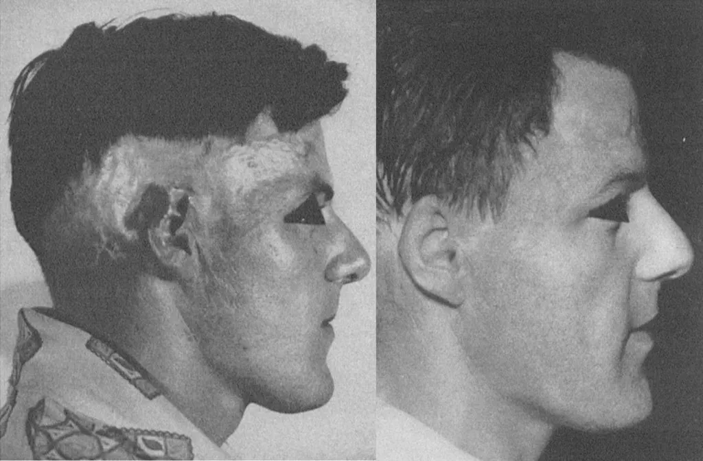 Primeras cirugías reconstructivas de alopecias cicatriciales por quemaduras mediante colgajos de piel pilosa.