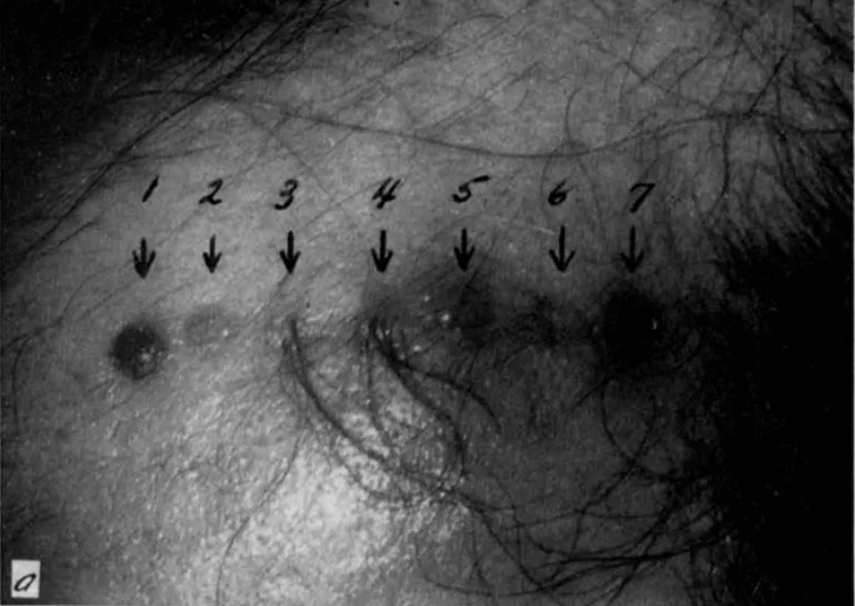 Los folículos implantados de zonas pobladas (del 3 al 7) crecen de manera idéntica a la zona extraída: dominancia donante.
