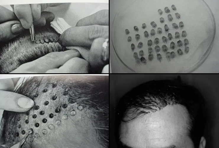 Cirugías de trasplante capilar con punch de 4mm, adquiriendo aspecto de “pelo de muñeca”.
