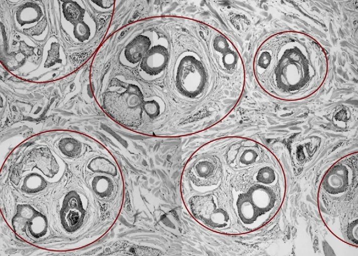 Imagen histopatológica de un corte transversal de la piel donde se observan las unidades foliculares y el perifolículo.