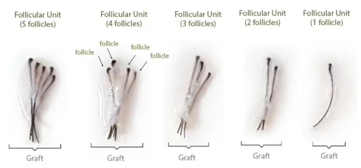 Unidades foliculares de 1 a 5 folículos.