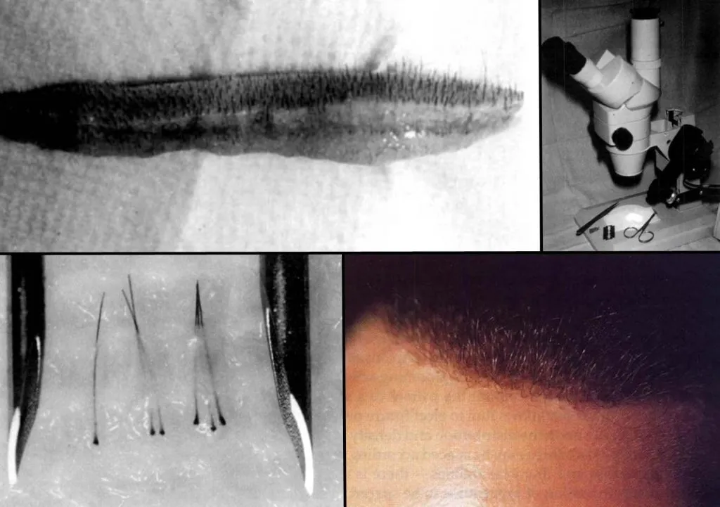 Inicios del trasplante de unidades foliculares (técnica FUSS) mediante extracción de tira y disección con microscopio, con resultados totalmente naturales.