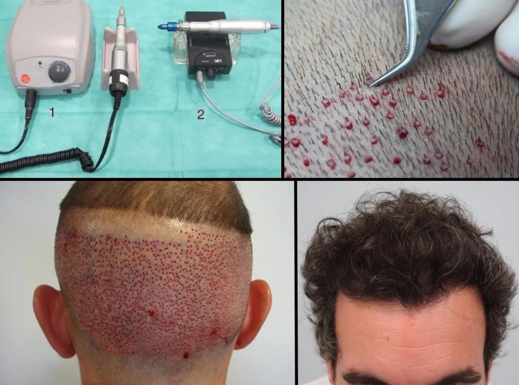 Técnica FUE con micromotor y punch 0,8mm, extracción de unidad folicular por unidad folicular, con resultados totalmente naturales.