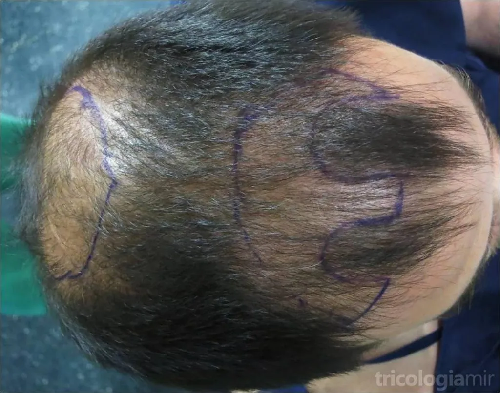Delimitamos las zonas tributarias a implantación para cálculo de unidades foliculares necesarias.