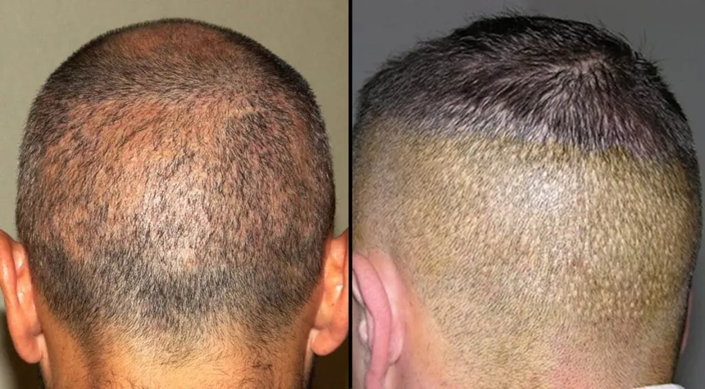 Alopecia apolillada por sobreexplotación de zona donante (izquierda) y white dots por utilización de punch demasiado grande (derecha).