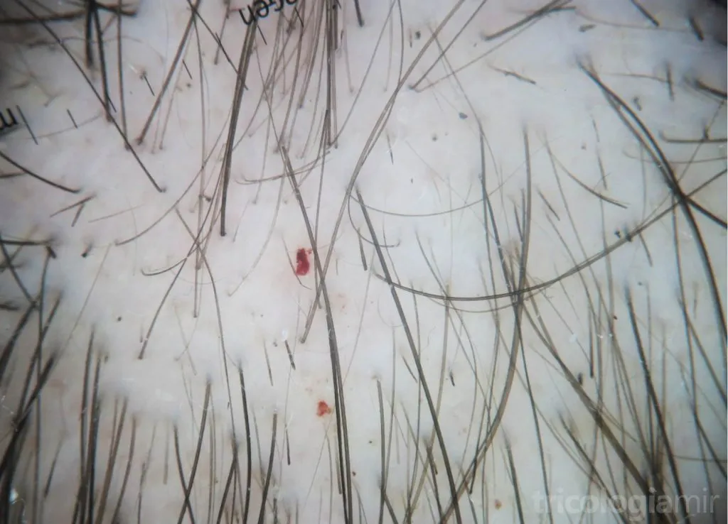 Tricoscopia con pelos rotos a diferentes niveles, puntos negros y hemorragia folicular