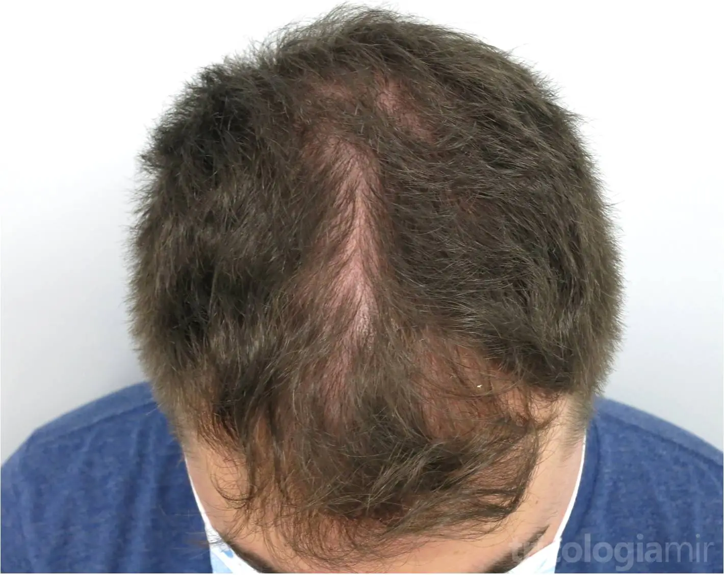 MAGA III previa a tratamiento con Minoxidil oral