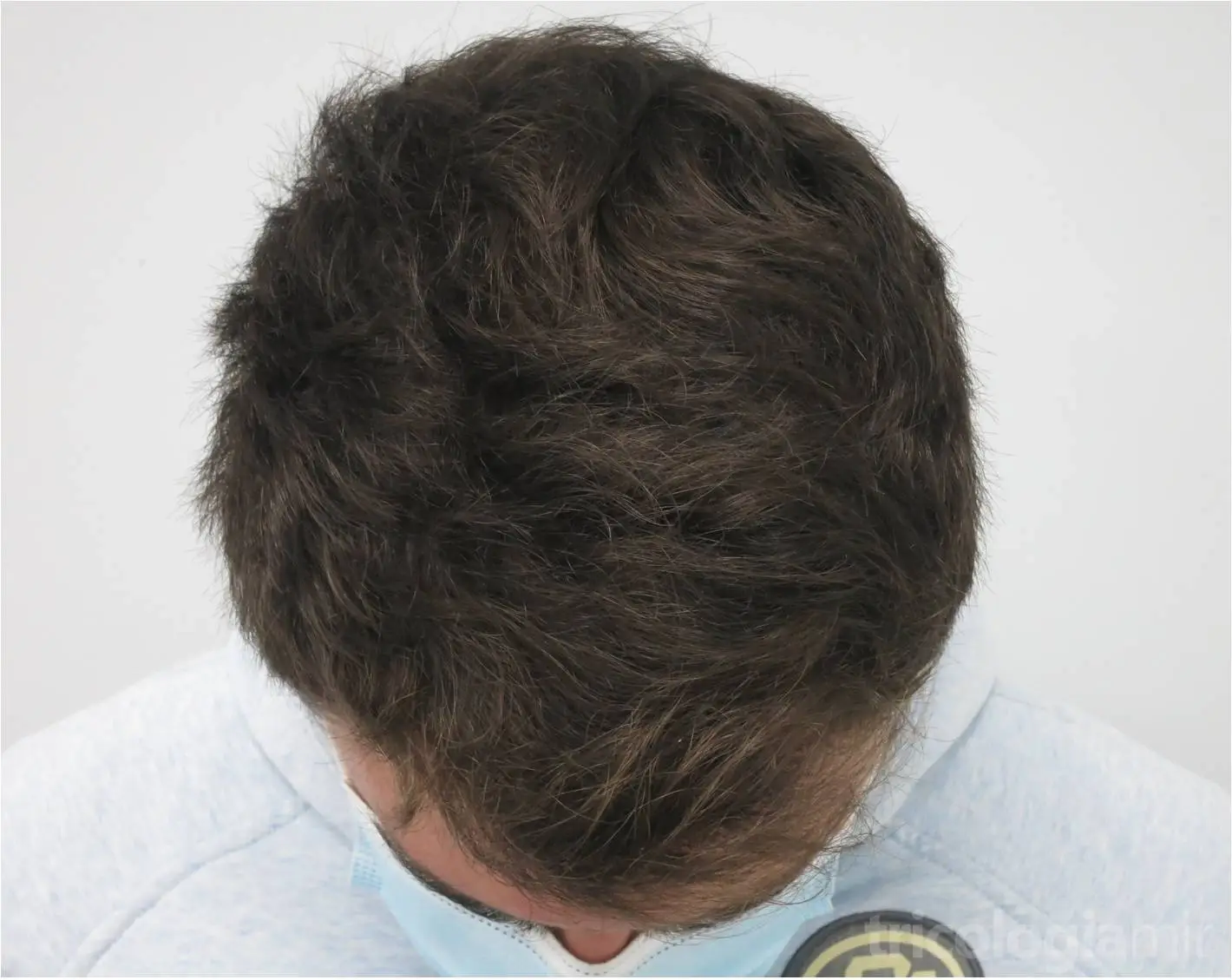 Mejoría notable tras 6 meses de tratamiento con Minoxidil oral 5mg/día