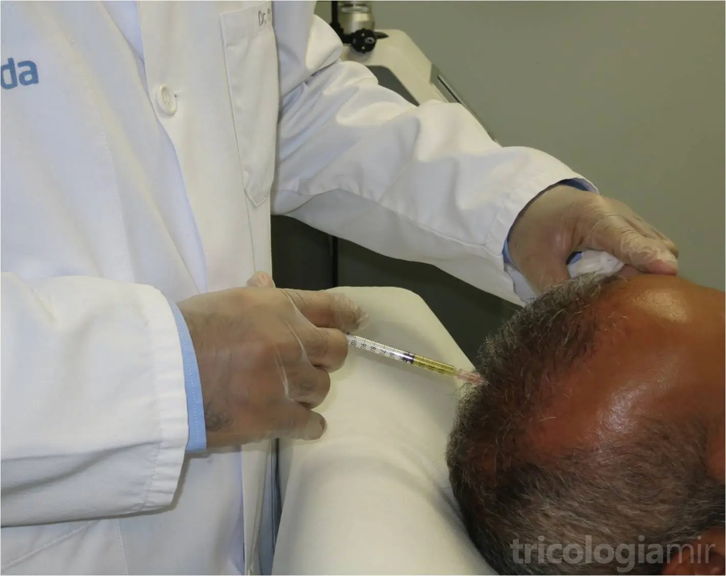 Aprovechamos el plasma rico en plaquetas para infiltrar directamente sobre el cuero cabelludo