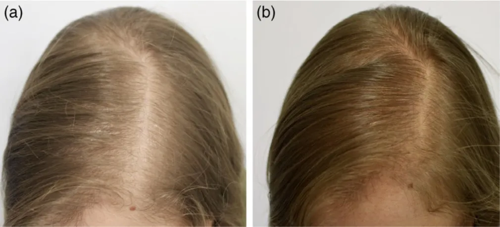 Mejoría clínica tras 6 meses de tratamiento con bicalutamida (Dermatol Ther. 2019 Nov;32(6):e13096.)