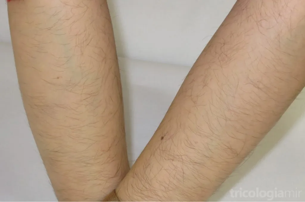 Hipertricosis localizada en brazos en una mujer joven en tratamiento con minoxidil oral 0,75mg/día