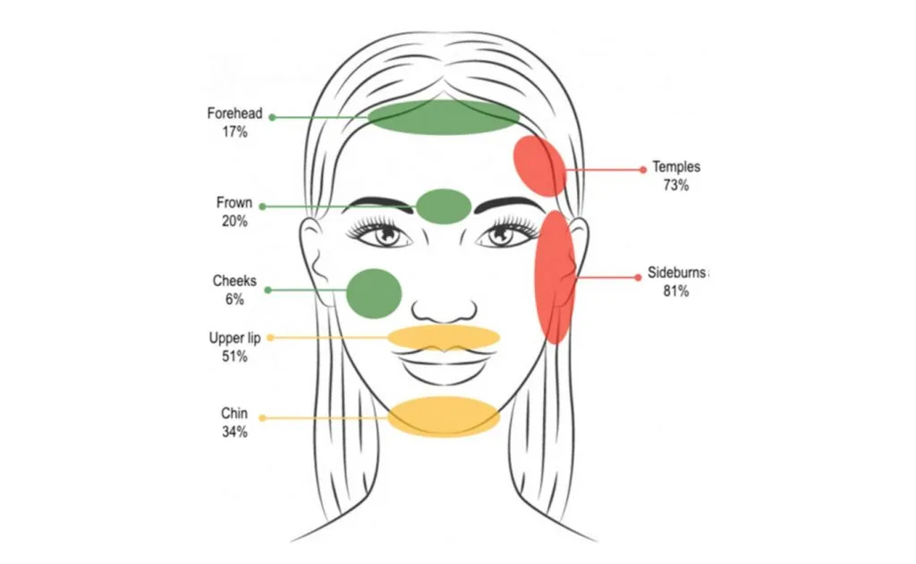 Frecuencia de aparición de hipertricosis por minoxidil oral según las zonas afectadas