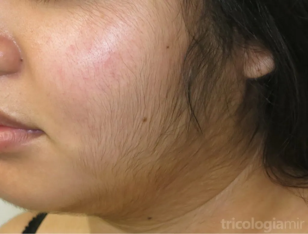 Hipertricosis severa en mujer joven producida por error de formulación en farmacia