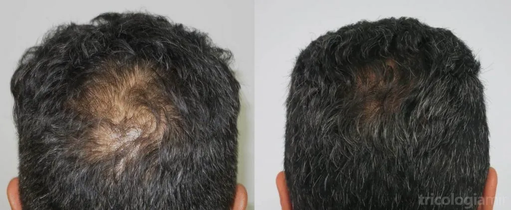Caso 1. Varón de mediana edad con alopecia en vértex donde se observa repoblación importante tras 2 sesiones de mesoterapia de dutasteride.