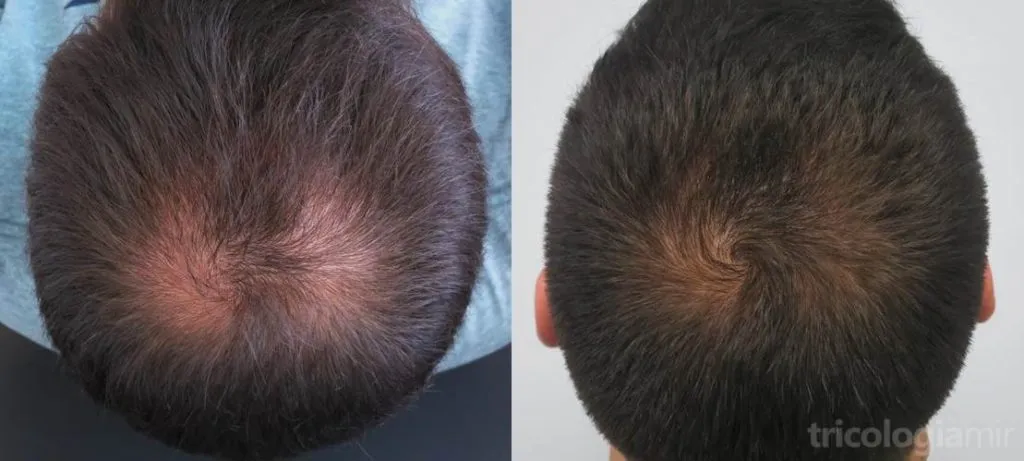 Caso 2 (visión posterior). Varón joven con repoblación notable de vértex tras 1 sola sesión de mesoterapia de dutasteride.