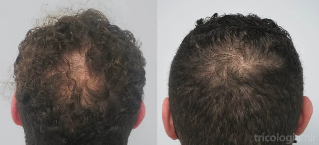 Caso 3. Varón de mediana edad con repoblación significante de coronilla tras 3 sesiones de mesoterapia de dutasteride.