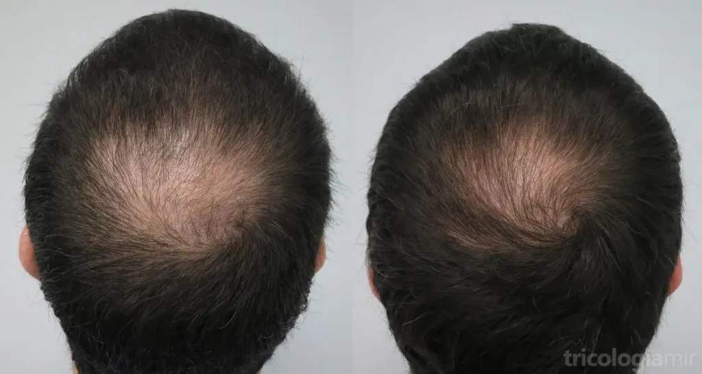 Caso 4 (visión postero-superior). Varón joven con alopecia vértex avanzada que conseguimos repoblar de manera parcial tras 3 sesiones de mesoterapia de dutasteride.