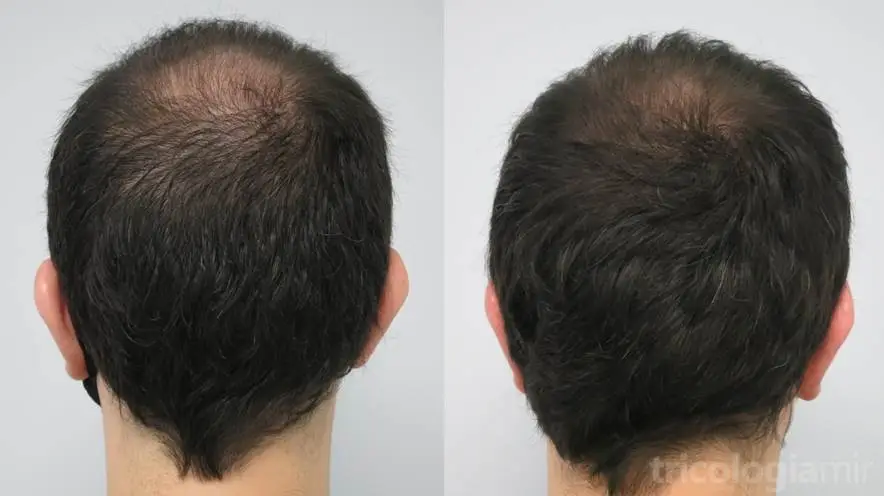 Caso 4 (visión posterior). Varón joven con alopecia vértex avanzada con cambio notable tras 3 sesiones de mesoterapia de dutasteride.