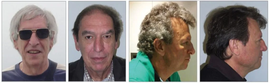 2 casos de repigmentación del pelo asociado a fármacos anti-PD-1/PD-L1.