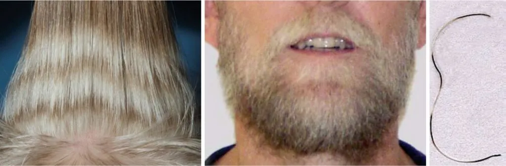 Los inhibidores de VEGF/VEGFR producen con frecuencia hipo/despigmentación del pelo.