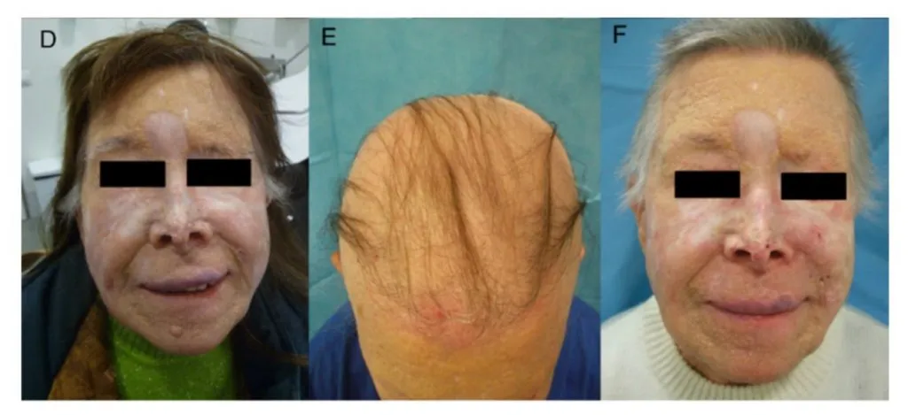 Los inhibidores de Hedgehog provocan una alopecia difusa, habitualmente reversible al cesar el tratamiento.