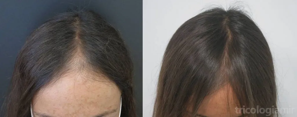Mujer de 34 años con FAGA a los 9 meses de tratamiento con minoxidil oral e infiltraciones de dutasteride.