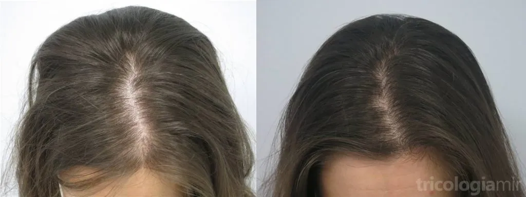 Mujer de 36 años con FAGA a los 6 meses de tratamiento con minoxidil oral.