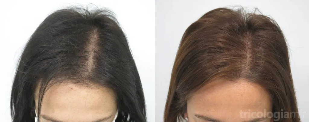 Mujer de 44 años con FAGA a los 12 meses de tratamiento con minoxidil oral, dutasteride oral e infiltraciones de dutasteride.