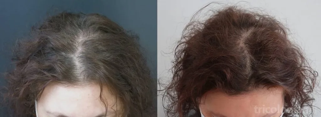 Mujer de 57 años con FAGA a los 9 meses de tratamiento con minoxidil oral, dutasteride oral e infiltraciones de PRP.
