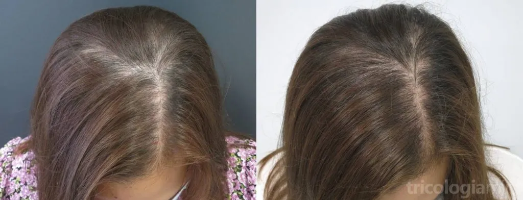 Mujer de 28 años con FAGA a los 12 meses de tratamiento con minoxidil oral e infiltraciones de dutasteride.